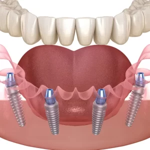 All on 4 Implant