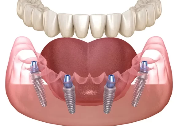 All on 4 Implant