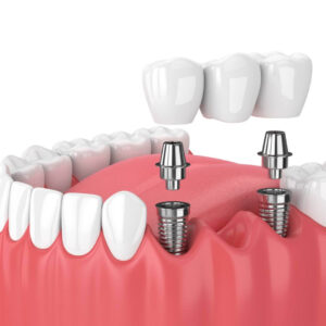 Dental Implants