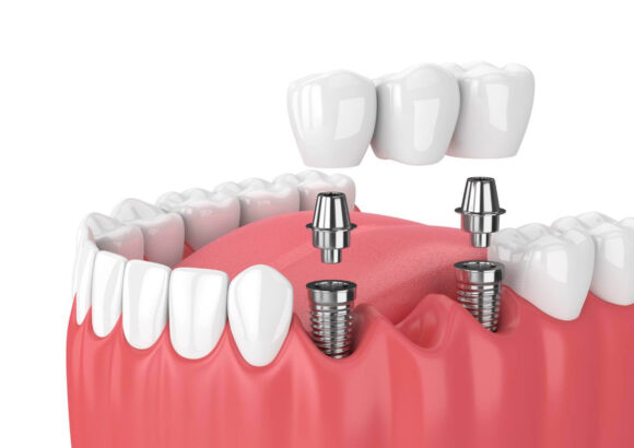 Dental Implants