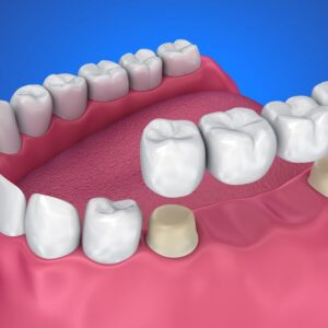 Zirconium Crowns