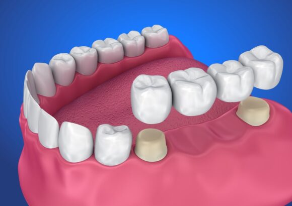 Zirconium Crowns